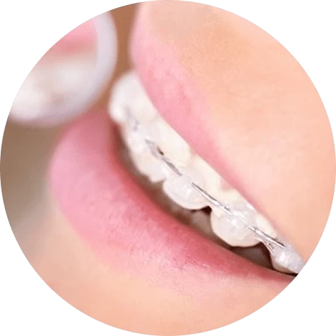 Баннер Поставить брекеты, исправить прикус Баннер Поставить брекеты, исправить прикус