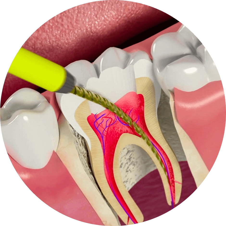 Баннер Лечение каналов — пульпита и периодонтита Баннер Лечение каналов — пульпита и периодонтита